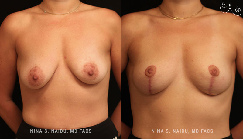 Breast Lift Before & After - Dr. Nina Naidu