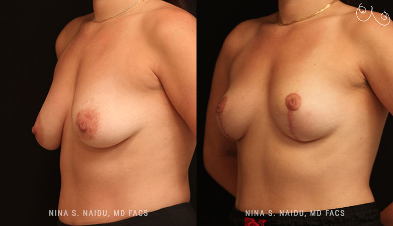 Breast Lift Before & After - Dr. Nina Naidu
