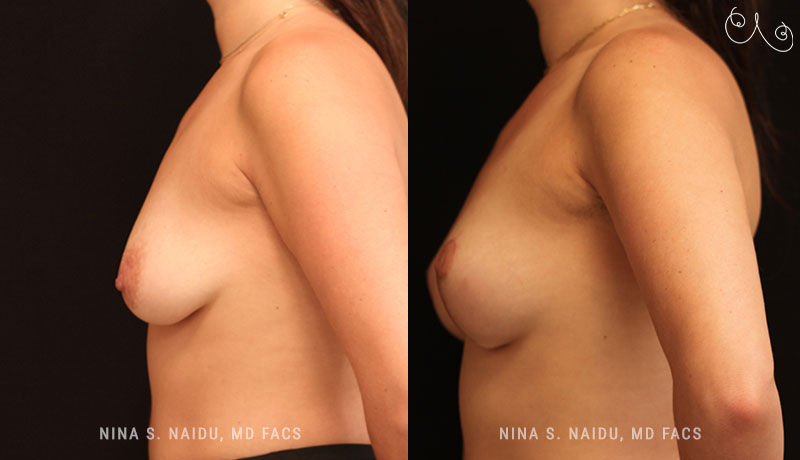 Breast Lift Before & After - Dr. Nina Naidu