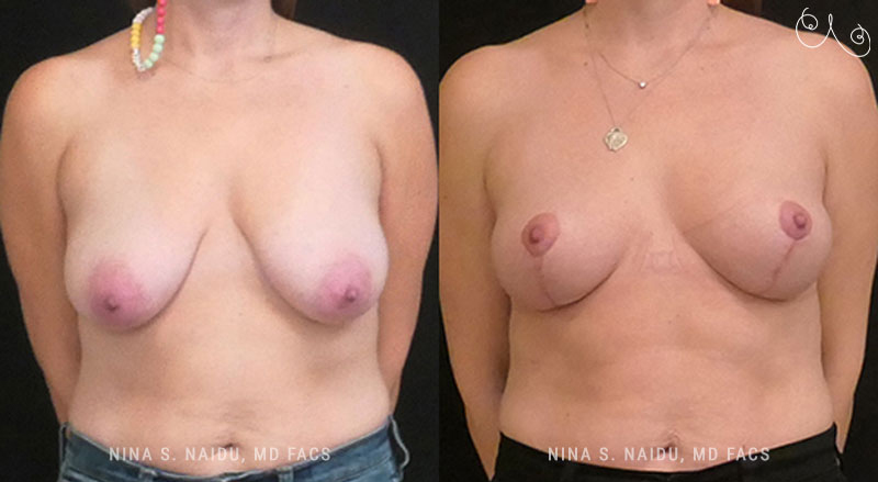 Breast Lift Before & After - Dr. Nina Naidu