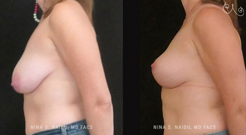 Breast Lift Before & After - Dr. Nina Naidu