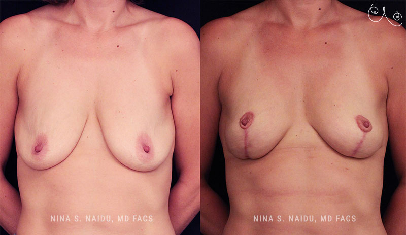 Breast Lift Before & After - Dr. Nina Naidu
