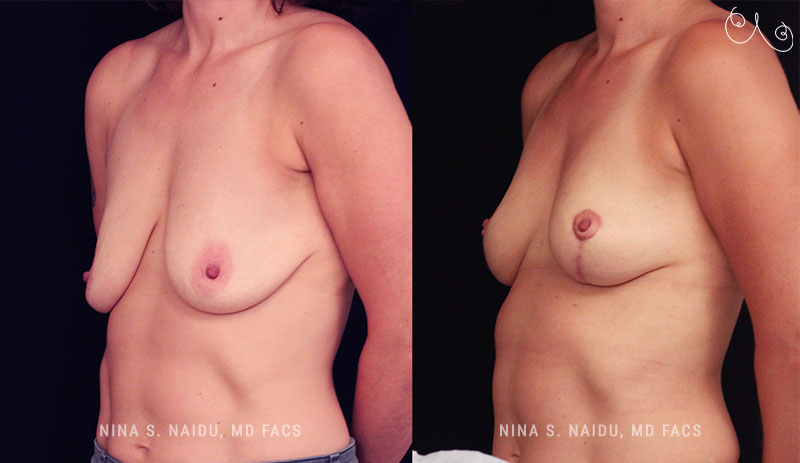Breast Lift Before & After - Dr. Nina Naidu