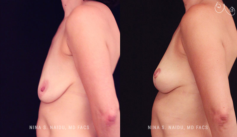 Breast Lift Before & After - Dr. Nina Naidu