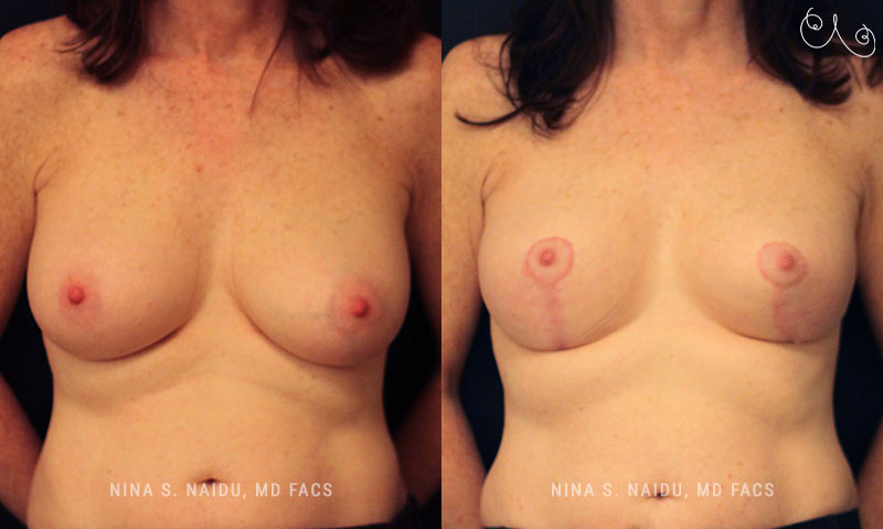 Breast Lift Before & After - Dr. Nina Naidu