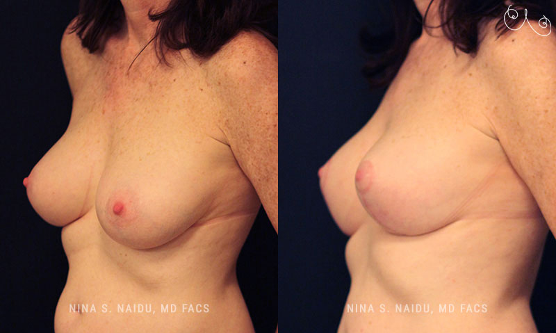 Breast Lift Before & After - Dr. Nina Naidu