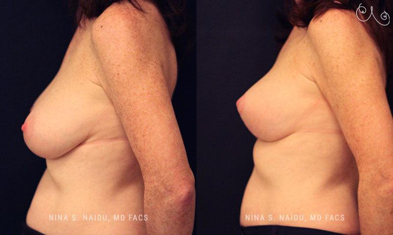 Breast Lift Before & After - Dr. Nina Naidu