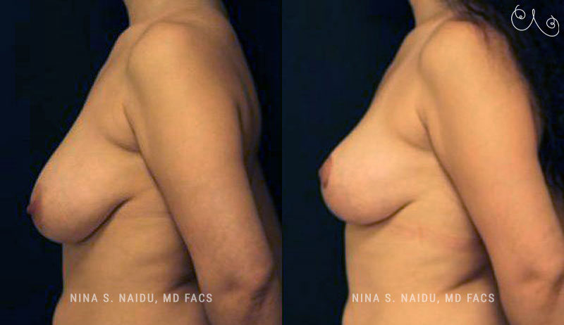 Breast Lift Before & After - Dr. Nina Naidu