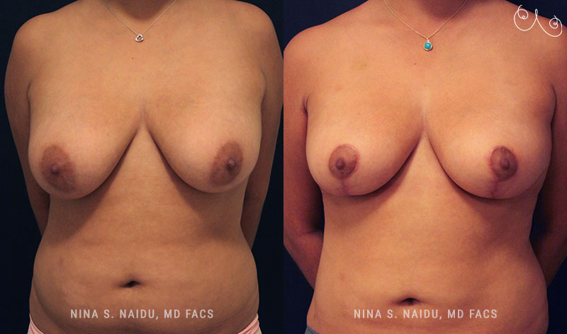 Breast Lift Before & After - Dr. Nina Naidu