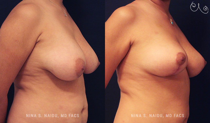 Breast Lift Before & After - Dr. Nina Naidu