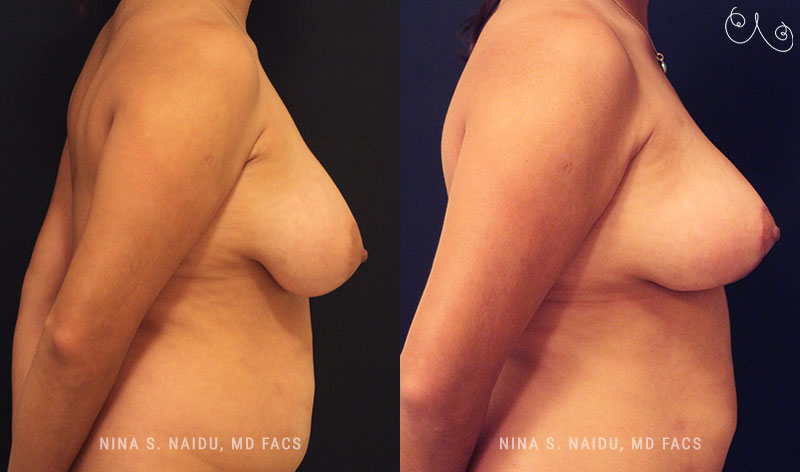 Breast Lift Before & After - Dr. Nina Naidu