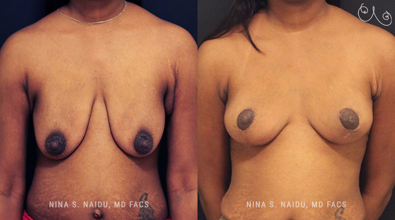 Breast Lift Before & After - Dr. Nina Naidu