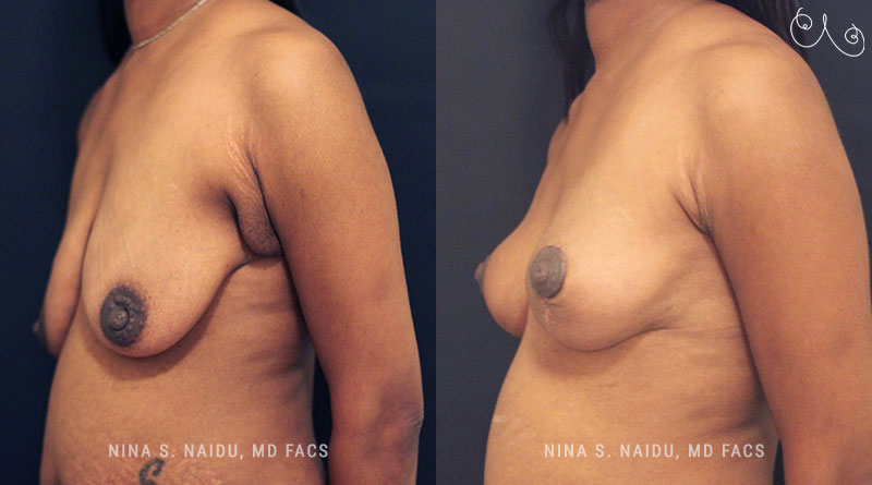 Breast Lift Before & After - Dr. Nina Naidu