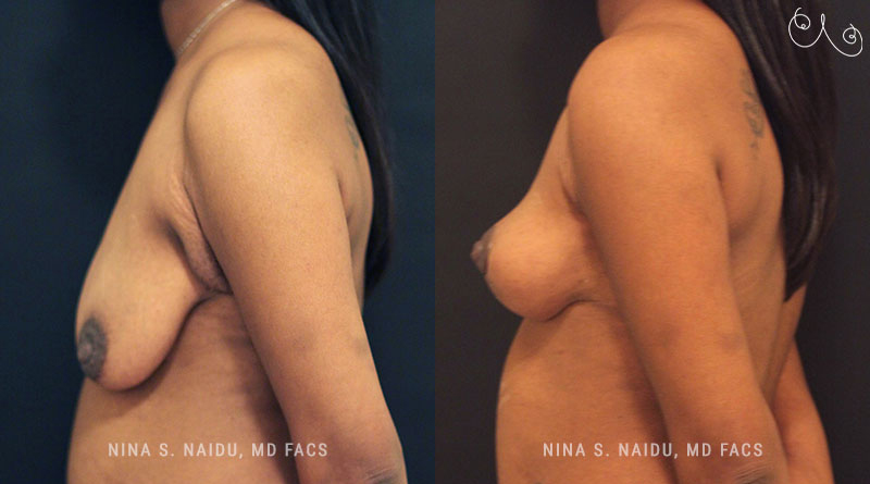 Breast Lift Before & After - Dr. Nina Naidu