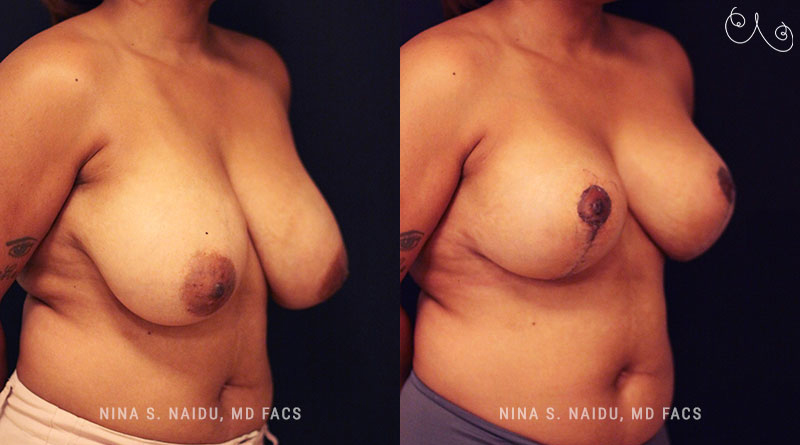 Breast Lift Before & After - Dr. Nina Naidu