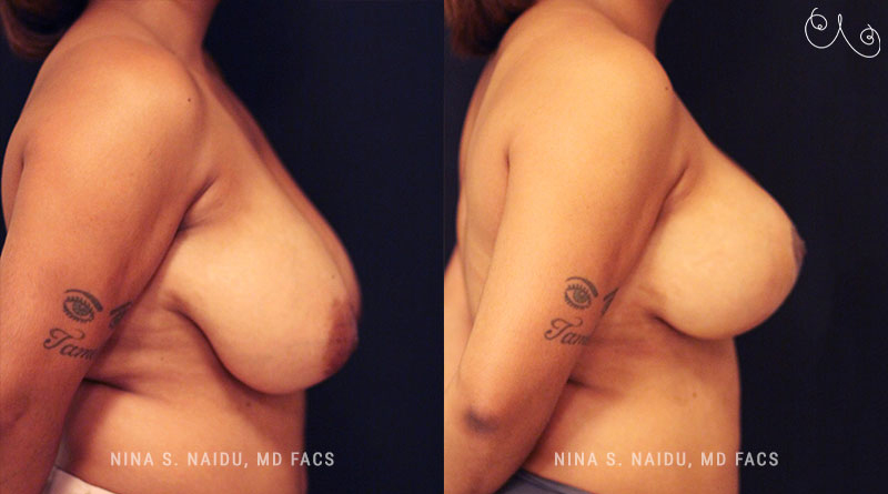 Breast Lift Before & After - Dr. Nina Naidu