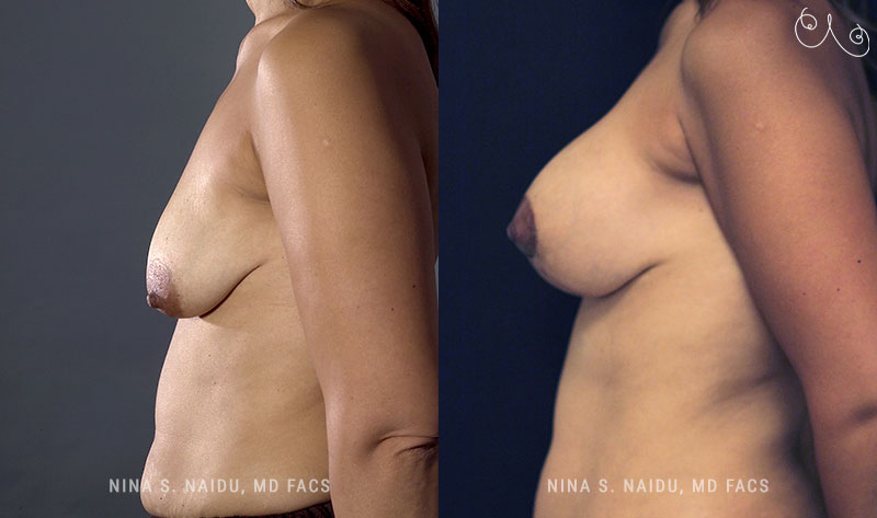 Breast Lift Before & After - Dr. Nina Naidu