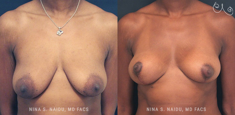 Breast Lift Before & After - Dr. Nina Naidu