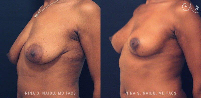 Breast Lift Before & After - Dr. Nina Naidu