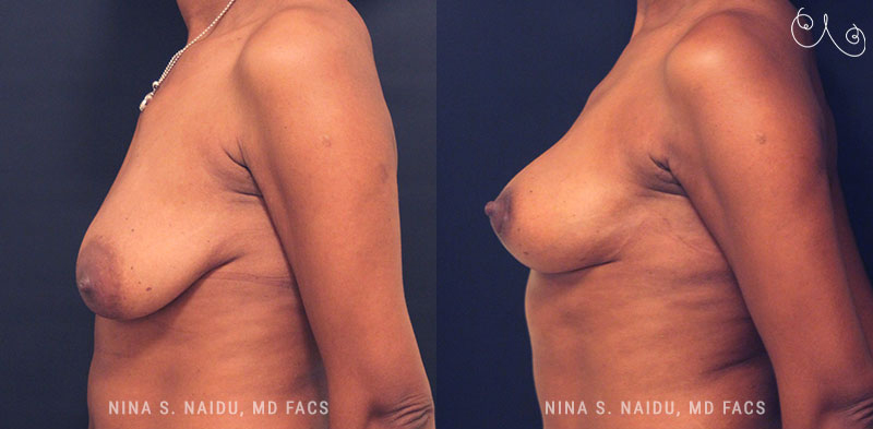 Breast Lift Before & After - Dr. Nina Naidu
