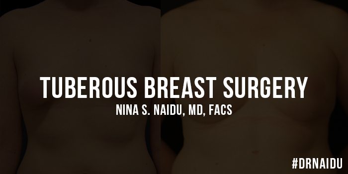 Tuberous Breast Surgery - NYC Tubular Breast Surgery
