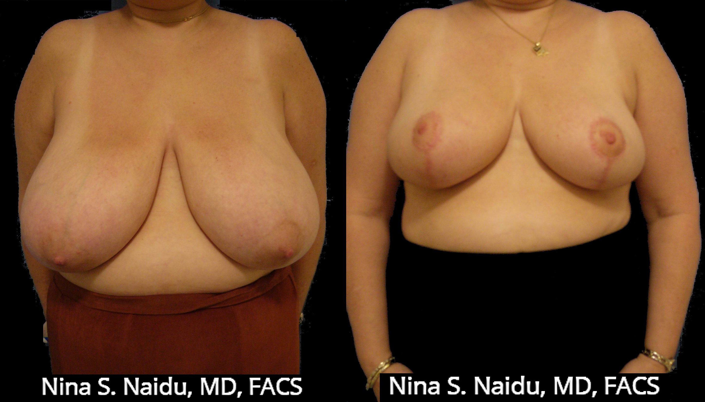 nude-breast-reduction-before-and-after-pics