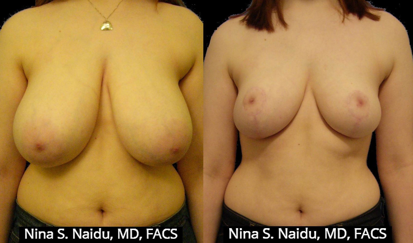 breast-reduction-before-and-after-pics-jap-handjob-videos
